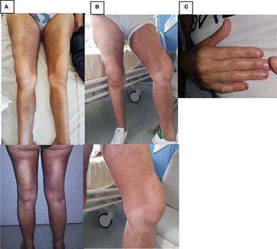 Frontiers H Syndrome Treated With Tocilizumab Two Case Reports And